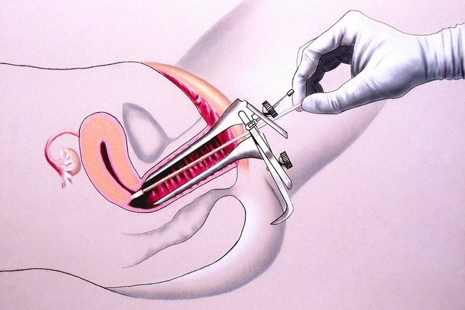 Cervical Cancer Prevention and Screening: Papsmear