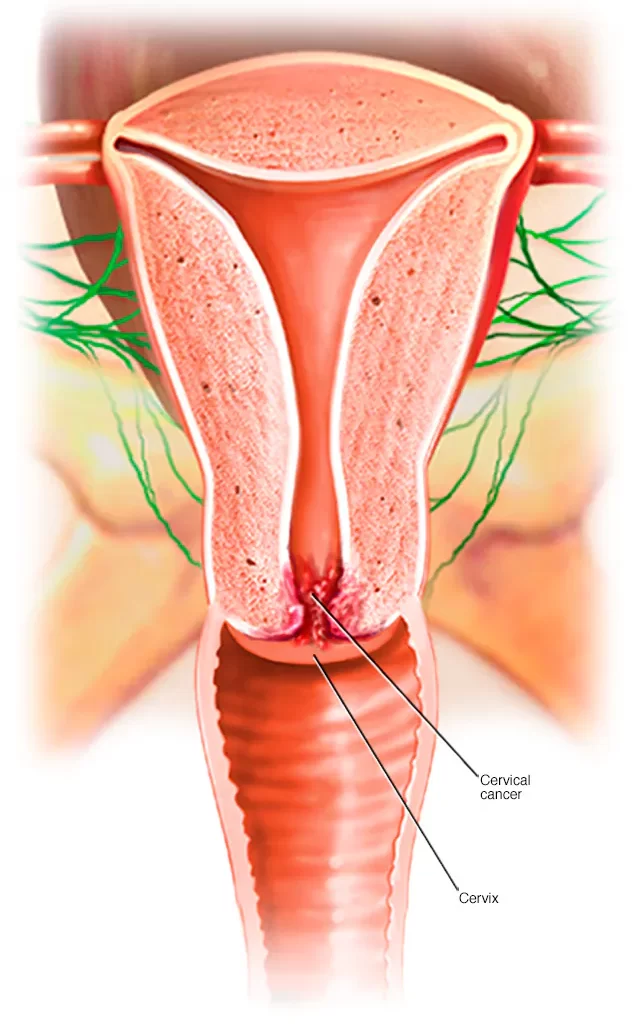Cervical Cancer